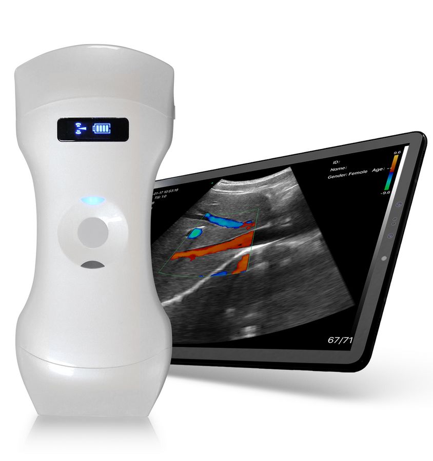 Ein tragbares Ultraschallgerät, das mit einem Tablet-Bildschirm verbunden ist. Der Bildschirm zeigt ein Ultraschallbild mit farbcodierten Bereichen.